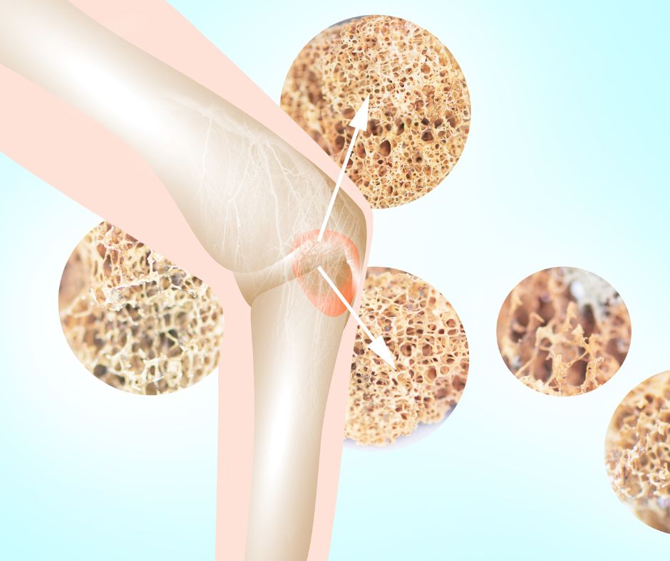 Osteoporosis - Illawarra Medical Centre